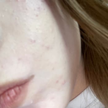 Paden Cosmetics Ürünü Kullandıktan Bir Gün Sonra Cildimde Alerji Ve Kabarcıklar Oluştu