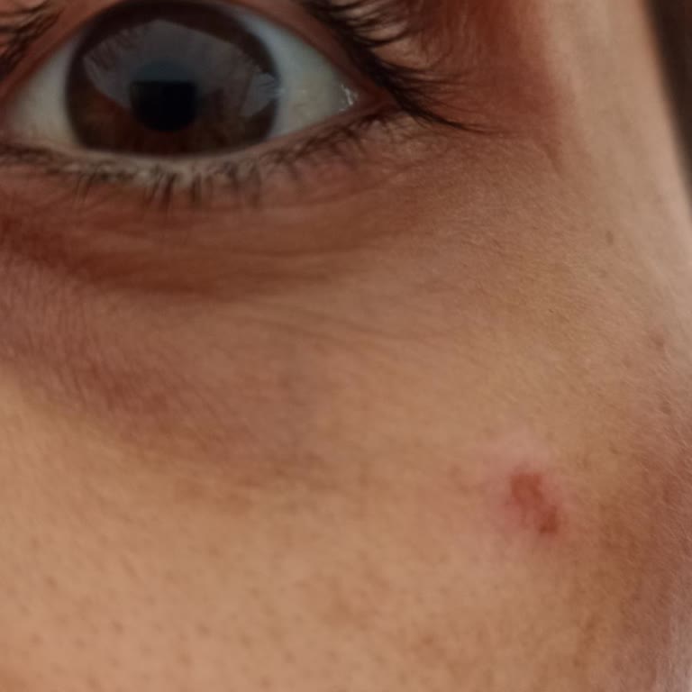 Aldığım Gözaltı Kapatıcısı Alerji Yaptı, Mağaza Çözüm Sunmadı