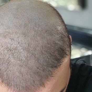 Saç Gölgelendirme Sonrası Renk Değişimi Ve Sürekli Hayal Kırıklığı