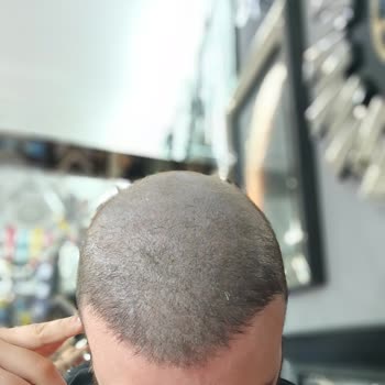 Saç Gölgelendirme Sonrası Renk Değişimi Ve Sürekli Hayal Kırıklığı