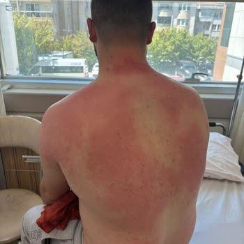 Lure Tüy Dökücü Krem Ciddi Bir Tahriş, Yoğun Ağrı, Kızarıklık Ve Yara Yaptı