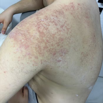 Lure Tüy Dökücü Krem Ciddi Bir Tahriş, Yoğun Ağrı, Kızarıklık Ve Yara Yaptı