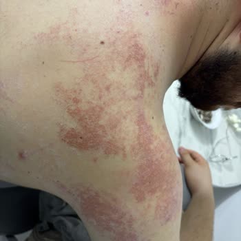 Lure Tüy Dökücü Krem Ciddi Bir Tahriş, Yoğun Ağrı, Kızarıklık Ve Yara Yaptı