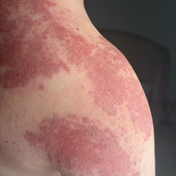 Lure Tüy Dökücü Krem Ciddi Bir Tahriş, Yoğun Ağrı, Kızarıklık Ve Yara Yaptı