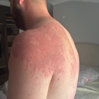 Lure Tüy Dökücü Krem Ciddi Bir Tahriş, Yoğun Ağrı, Kızarıklık Ve Yara Yaptı