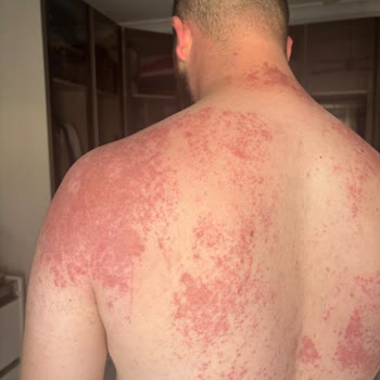 Lure Tüy Dökücü Krem Ciddi Bir Tahriş, Yoğun Ağrı, Kızarıklık Ve Yara Yaptı