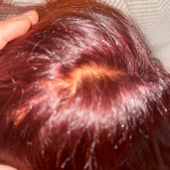 Saç Boyası Kullanımı Sonrası Yanma Ve Tahriş Yaşadım, İade Talep Ediyorum