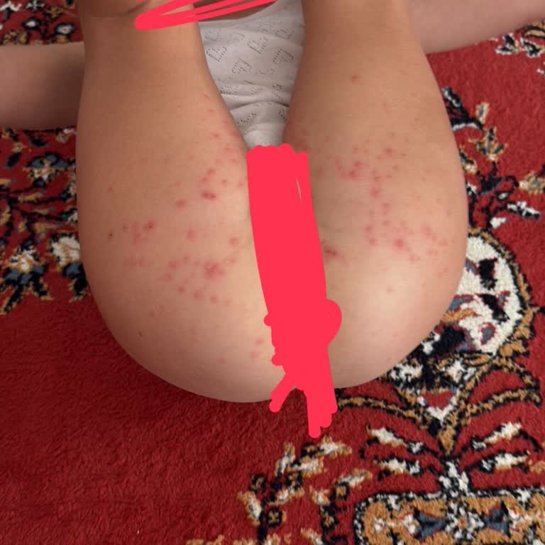 Belek Otelinde Hijyen Eksikliği Ve Sağlık Sorunlarıyla Mağduriyet Yaşadık