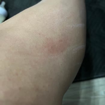 Epify Tüy Dökücü Ürün Cildimde Şiddetli Tahrişe Ve Yaralara Sebep Oldu