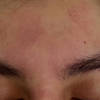 Eyüp Sabri Tuncer Gül Suyu Cildimde Yanma ve Kızarıklık Yaptı