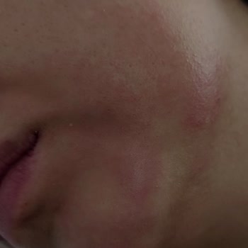 Eyüp Sabri Tuncer Gül Suyu Cildimde Yanma ve Kızarıklık Yaptı