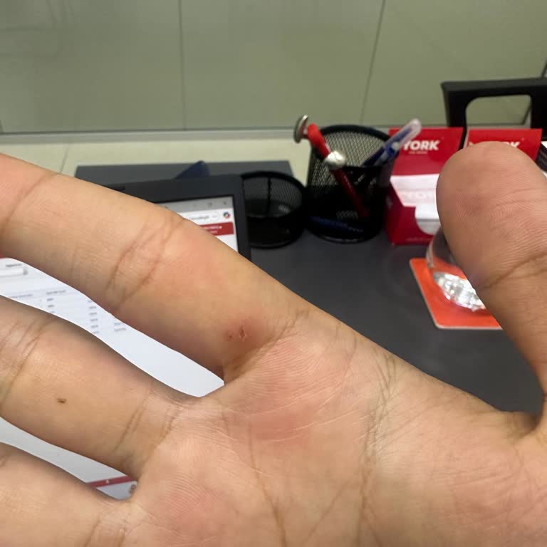 Dyson V15s Detect Submarine Modelinde Ergonomi Kaynaklı Parmak Yaralanması