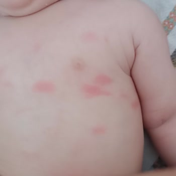 Bebeğimizde Ciddi Alerji Yapan Mama İçin Acil Ücret İadesi Talebi