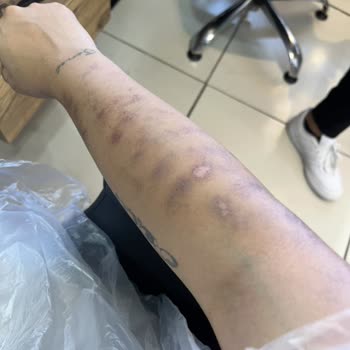 Lazer Epilasyon Sonrası Yanık Ve İlgisiz Yaklaşım Nedeniyle Mağduriyet