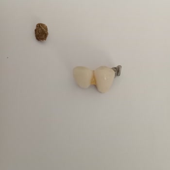 BİM'den Aldığım Müsli İçinden Taş Çıktı, Dişimi Kırdı: Sağlığım Tehlikeye Girdi Ve Mağduriyetim Giderilmiyor