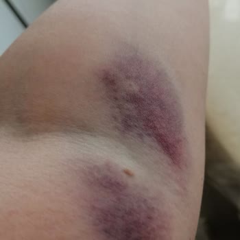 Acil Serviste İlgisiz Hemşire Nedeniyle Annemin Kolu Morardı Ve Kimse Özür Dilemedi