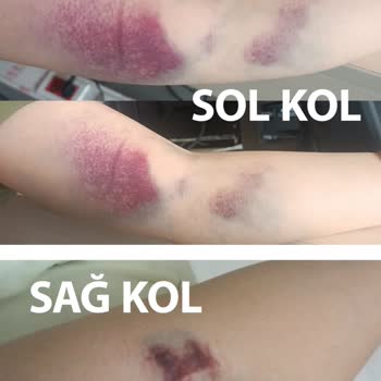 Türk Kızılay Gönüllü Kan Bağışında İhmalkar İşlem Sonucu İki Kolda Kalıcı Hasar