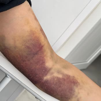 Türk Kızılay Gönüllü Kan Bağışında İhmalkar İşlem Sonucu İki Kolda Kalıcı Hasar