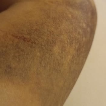 Türk Kızılay Gönüllü Kan Bağışında İhmalkar İşlem Sonucu İki Kolda Kalıcı Hasar