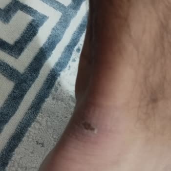 İlk Giyişte Yara Yapan Ayakkabıya Çözüm Bulunmadı