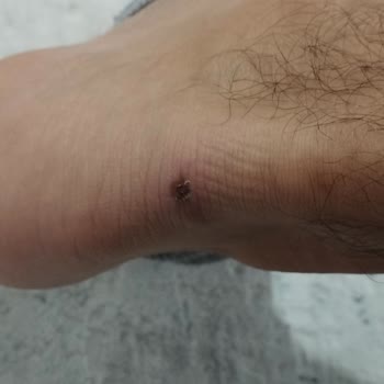 İlk Giyişte Yara Yapan Ayakkabıya Çözüm Bulunmadı