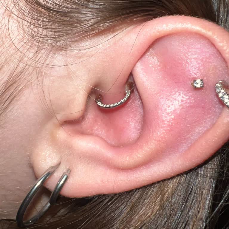 Yanlış Küpe Seçimi Nedeniyle Kızımın Kulağında Şiddetli Enfeksiyon Ve Mağduriyet