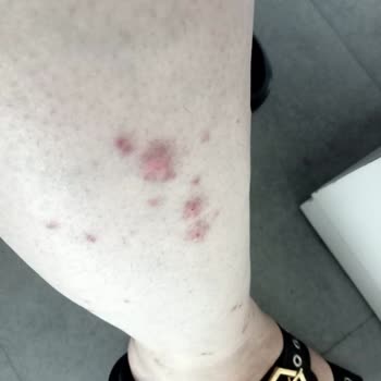 Fethiye Otelinde Böcek Sorunu Ve Ücret İadesi Talebi