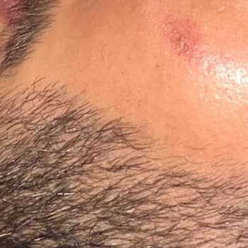 Lazer İşlem Sonrası Ciddi Yanıklar Ve İlgisizlik Mağduriyetimi Artırdı