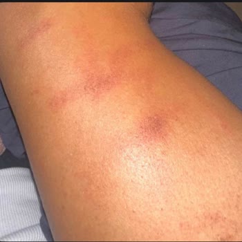 Lazer İşlem Sonrası Ciddi Yanıklar Ve İlgisizlik Mağduriyetimi Artırdı