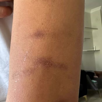 Lazer İşlem Sonrası Ciddi Yanıklar Ve İlgisizlik Mağduriyetimi Artırdı