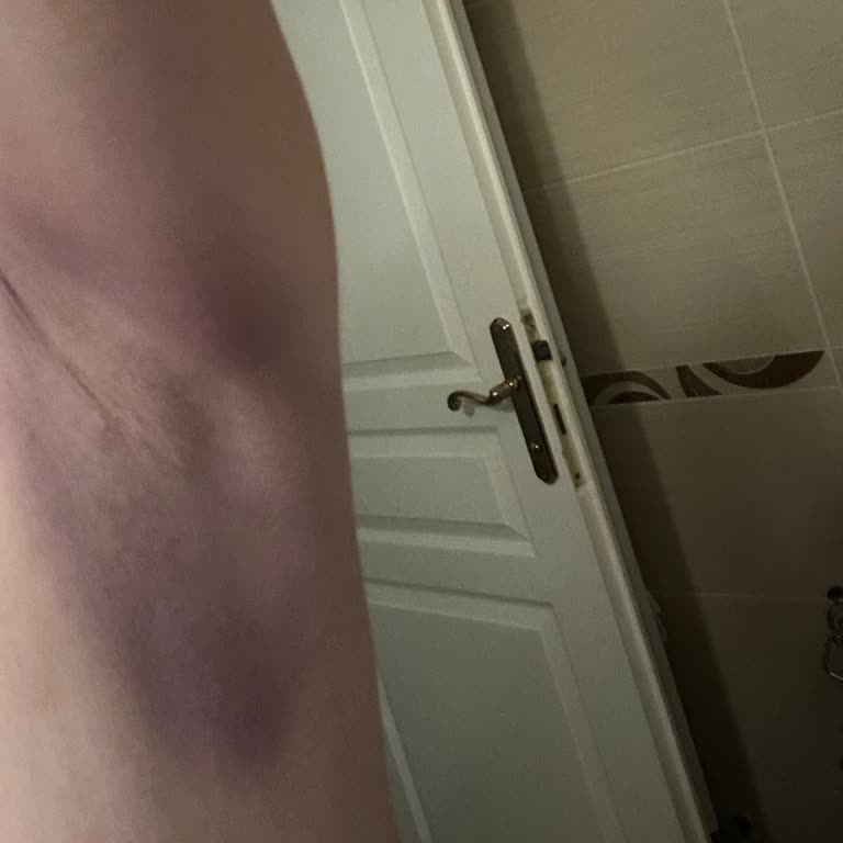 Yelekten Cilde Geçen Boya: Sağlık Riski Ve İade Sorunu