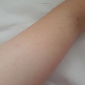 Veet Tüy Dökücü Krem Cildimde Şiddetli Alerjik Reaksiyona Sebep Oldu