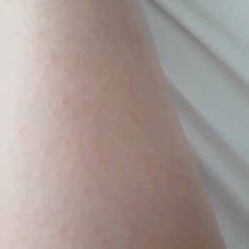 Veet Tüy Dökücü Krem Cildimde Şiddetli Alerjik Reaksiyona Sebep Oldu