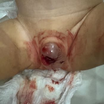 Sünnet Sonrası Ciddi Komplikasyonlar Ve Yetersiz Doktor İlgisi