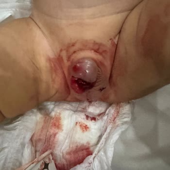 Sünnet Sonrası Ciddi Komplikasyonlar Ve Yetersiz Doktor İlgisi