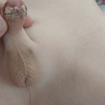 Sünnet Sonrası Ciddi Komplikasyonlar Ve Yetersiz Doktor İlgisi