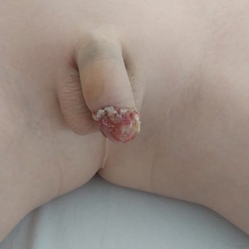 Sünnet Sonrası Ciddi Komplikasyonlar Ve Yetersiz Doktor İlgisi