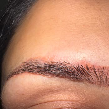 Kaş Pudralama İşlemi Sonrası Kalıcı Hasar Ve Yetersiz Bilgilendirme