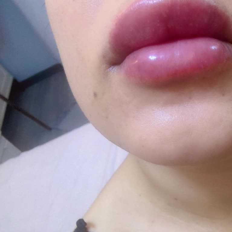 Luxe Clinic | Bakırköy Dudak Dolgusu Sonrası Doğallık Sorunu Ve Memnuniyetsizlik