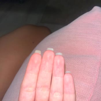 Jel Tırnak İşlemi Sonrası Acı Ve Memnuniyetsizlik Yaşadım