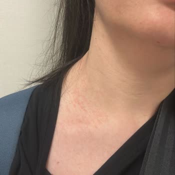 Alerji Yapan Kolye Sonrası Markadan Haftalardır Yanıt Alamıyorum