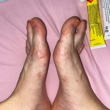 Ayak Peeling Çorabı Sonrası Alerjik Reaksiyon Ve Yetersiz Uyarı