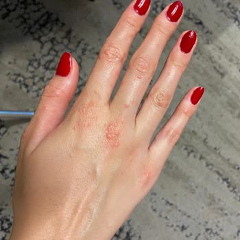 Ayak Peeling Çorabı Sonrası Alerjik Reaksiyon Ve Yetersiz Uyarı