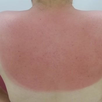 Aldığım Güneş Spreyi Cildimde Yanıklara Sebep Oldu, Ürün Orijinalliği Ve Satıcı Denetlensin