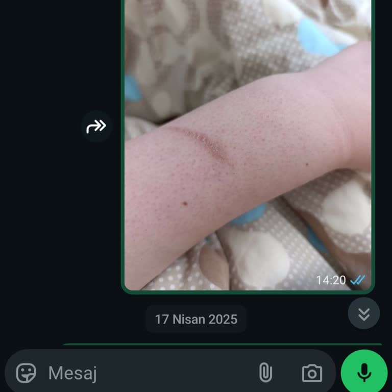 Lazer Epilasyon Sonrası Yanık Ve İlgisizlik Nedeniyle Mağduriyet