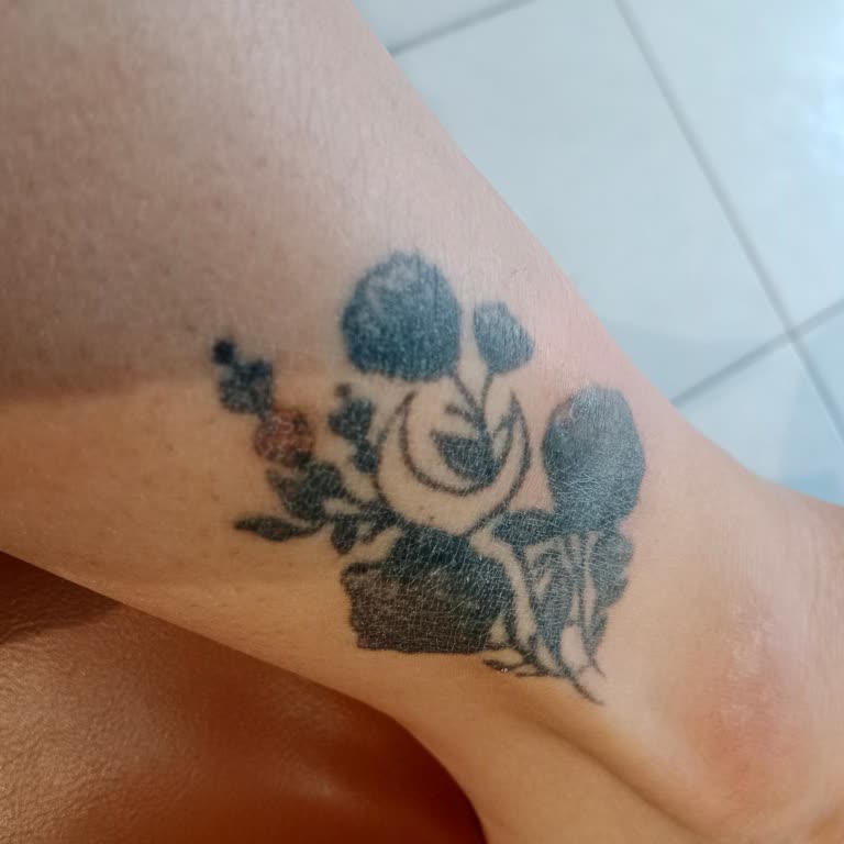 Lazer Epilasyon Sonrası Yanık Ve İlgisiz Personel Nedeniyle Mağduriyet Yaşadım