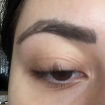 Kirpik Lifting Sonrası Zarar Ve İlgisiz Yaklaşım Mağduriyet Yarattı