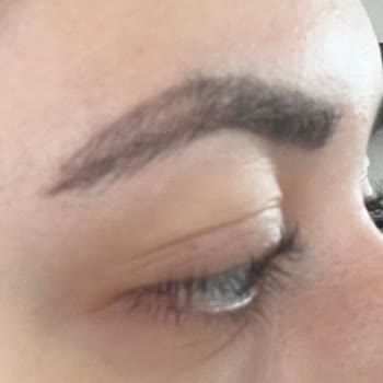 Kirpik Lifting Sonrası Zarar Ve İlgisiz Yaklaşım Mağduriyet Yarattı