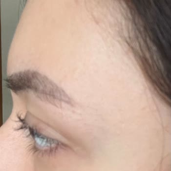 Kirpik Lifting Sonrası Zarar Ve İlgisiz Yaklaşım Mağduriyet Yarattı