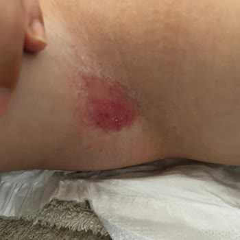 Molfix Bebek Bezi Cilt Sorununa Yol Açtı, Ücret İadesi Talep Ediyorum